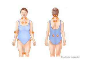 Fibromyalgia Tender Points