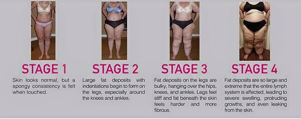 Stages of Lipedema