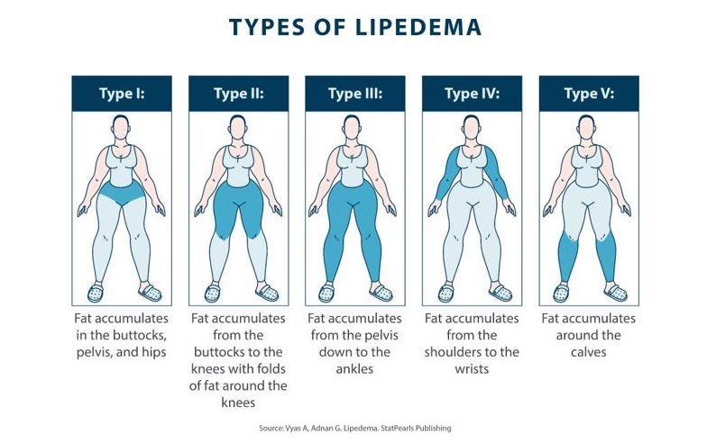 Types of Lipedema